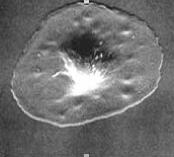 Rasterelektronenmikroskopische Aufnahmen zeigen einen ruhenden Thrombozyten mit diskoider Form (Bild 1, links, x 3000), einen flach ausgespreizten Thrombozyten nach dem Calciumeinstrom in das