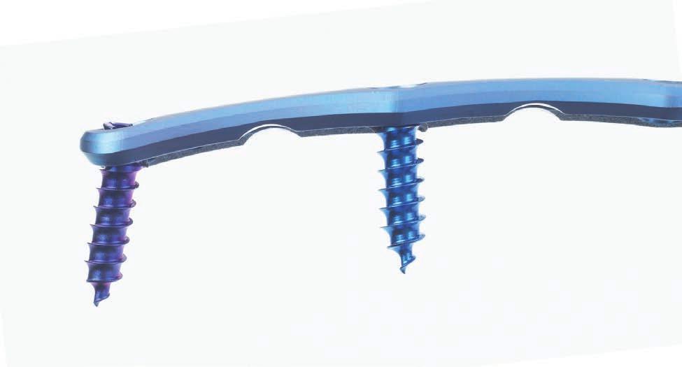 Vectra. Das flexible, einfach zu handhabende anteriore HWS-Plattensystem. Platten Integrierter Verriegelungsmechanismus Vorlordosiert Großes Sichtfenster für Knochenmaterial 16.5 mm breit und 2.