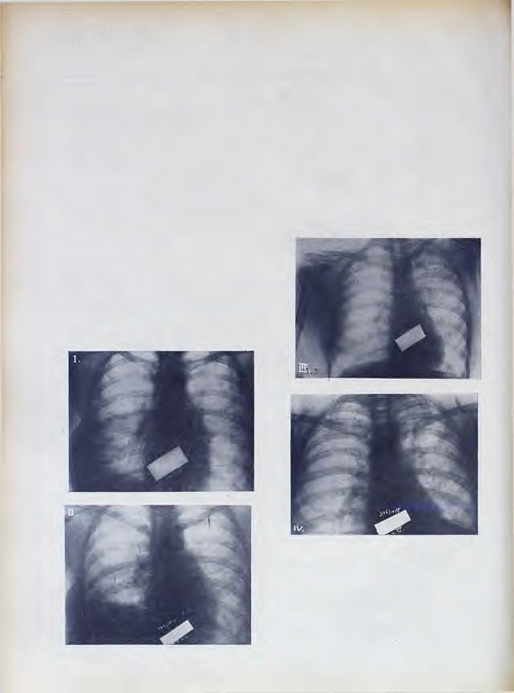 466 Bronhijalno disanje nad kavernom poslije operacije prešlo u hrapavo vezikularno. Rentgenološki velika kaverna iščezla (vidi rentgenogram br. 3 i br. 4).
