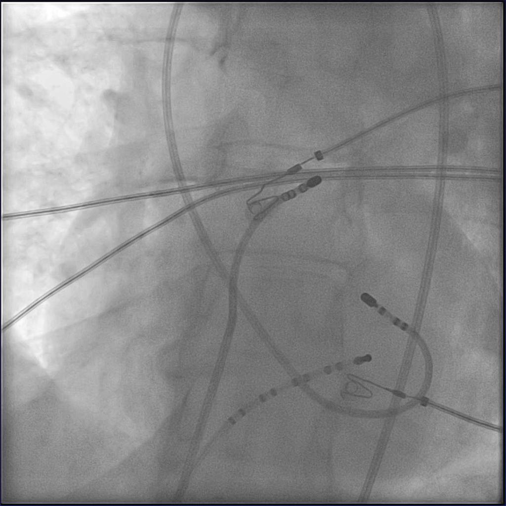 Ablation von LVOT - VES an der aorto-mitralen