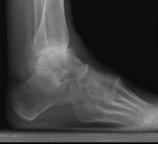 Röntgenbild oberes Sprunggelenk normal von vorne Röntgenbild oberes Sprunggelenk mit Arthrose von vorne Redondrainage Bei ambulanten Operationen wird in der Regel kein Schlauch (Redondrainage) zum