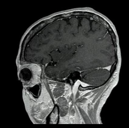 a patient with lymphoma that persisted after