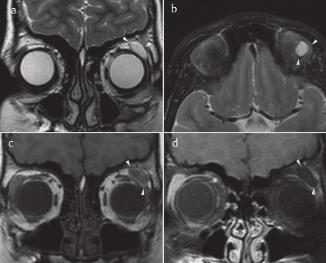 Es lässt sich eine kräftige KM-Aufnahme (c koronar, d sagittal) in den fettgesättigten T1-gewichteten Aufnahmen nachweisen. Abb. 8 Optikusneuritis bei einem 15-jährigen Mädchen.