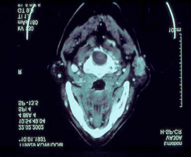 Tumor axiales CT eines Basalzelladenokarzinoms links Tumor CT desselben Basalzelladenokarzinom links andere Schicht Das makroskopische Tumorkorrelat ist unter 1.4.6.
