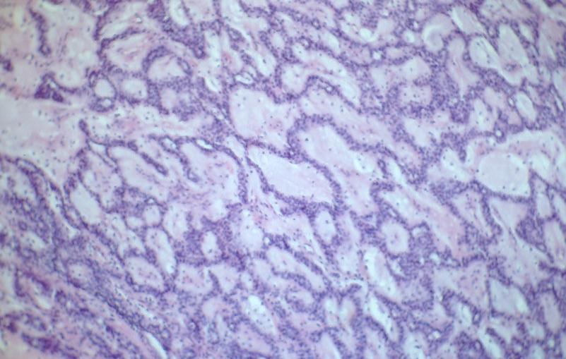 2.1.4.1.2. Trabekuläres und tubuläres Basalzelladenom Die trabekuläre und tubuläre Form haben als Hauptkomponenten basaloide Zellen, welche in länglichen, eng beieinander liegenden bandähnlichen