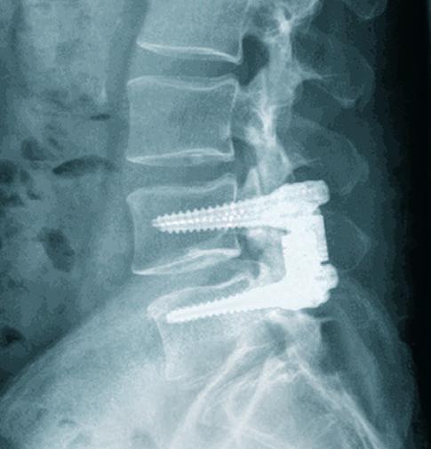 Die implantierten Schrauben dienen als Befestigung für die dynamische Verbindung zwischen den beiden Wirbelkörpern.