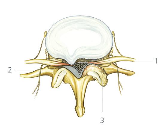 Wirbel körper und Wirbelbögen bilden den Wirbelkanal, in dem sich die Rücken marks nerven befinden und von äußeren Einwirkungen