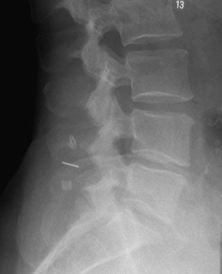 Abb. 4 8 Röntgen der LWS im seitlichen Strahlengang postoperativ: Lysesaum am Unterrand des Dornfortsatzes von LWK4 nach Implantation eines Wallis-Implantats LWK4/5 Abb.