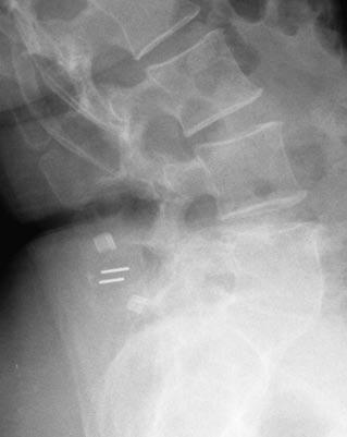 gespannten Polyesterbändern Indikationen waren: F Spinalkanalstenosen, F Rezidiv oder Massenvorfälle mit beginnender Instabilität, F Anschlussdegenerationen ohne wesentliche Instabilität nach