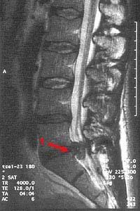Entstehungsursachen des Rückenschmerzes: Bandscheibe: Vorfall mit Nervenkompression