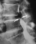 Entstehungsursachen des Rückenschmerzes: Knöcherne Strukturen: Osteochondrose, Spondylarthrose
