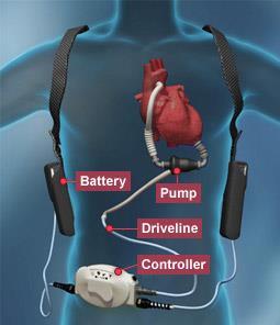 Ventrikuläre Assist Devices (VAD) pumpen das Blut mechanisch aus den insuffizienten Ventrikeln bzw. Vorhöfen in die Aorta oder Pulmonalarterie.