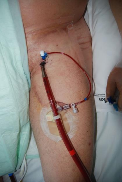 Implantiert wurden alle Kanülen peripher, vorzugsweise perkutan nach Ultraschalluntersuchung in Seldinger Technik, in zwei Fällen war ein chirurgischer Eingriff an der Arteria subclavia notwendig.