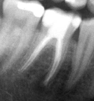 nach der endodontischen Behandlung neu aufgetreten ist oder eine vorher existierende Läsion an Größe zugenommen hat.