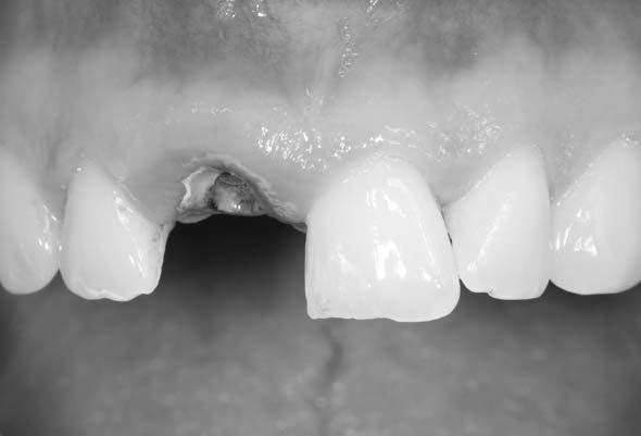durchschnittlich 80-90% über 10 Jahre ergibt, abhängig von der prothetischen Suprakonstruktion (20, 21). Abb. 9.1. Ausgangsbild Zahn 11 mit gelockertem Siftaufbau, insuffizienter WF und apikaler Läsion.