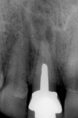 Entfernung des Zahnes und 6 Wochen Abheilung. Abb. 9.3. Insertion eines Straumann-Implantates mit 4,1mm Durchmesser.