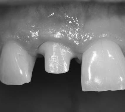 (20) die Langlebigkeit von Zähnen mit der von Implantaten verglichen. Sie kommen zu dem Schluss, dass die Überlebensquote von Implantaten nicht besser ist als die von natürlichen Zähnen.