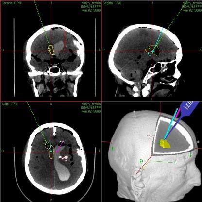 Prinzip der Neuronavigation 3D Kamera Patienten und