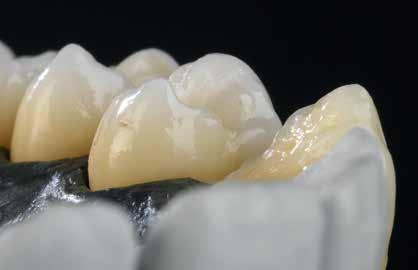 der Aufbau hingegen mit Dentin-Grundfarbe eingefärbt wurde 02-05 Zahn 13: anatomisch reduziertes Gerüst