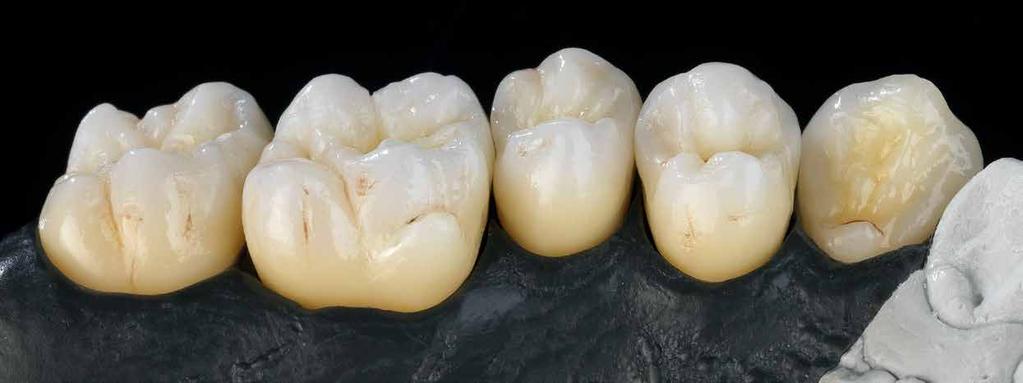 Zolid Classic, Vestibulärfläche reduziert und mit Keramik verblendet; Zähne 16 und 17 monolithische