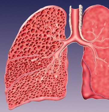 Die Lunge bei einem Lungenemphysem Man sieht