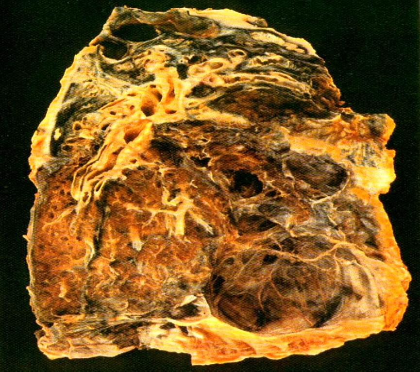 Endstadium eines Lungenemphysems mit riesigen Blasen (Bullae) Die Schweregrade der COPD (nach GOLD 2003) 0 gefährdet keine Symptome, Lufu normal I mild FEV 1 > 80 % d.s. FEV1/VC > 70 % des Solls II moderat FEV1 50 80 % d.
