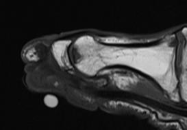 MRI-Osteomyelitis Weichteile