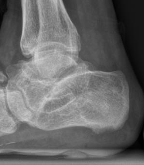 Konventionelles Röntgen Ossäre Veränderungen bei Osteomyelitis: -