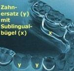 Ob zum Zahnlückenschluss ein Implantat die optimale Lösung ist, muss stets im konkreten Einzelfall entschieden werden (dazu abschließend im nächsten Teil).