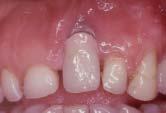 Während die endodontischen Maßnahmen als der letzte Versuch eigene Zähne zu erhalten definiert werden könnte, sind die Implantate dafür indiziert, um fehlende und nicht bestehende und