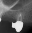 Die meisten Komplikationen, die im Rahmen einer endodontischen Behandlung entstehen können und als typische Risiken gelten, wie z.b.