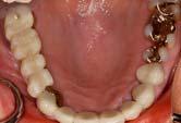 Der Abszess wurde zunächst chirurgisch durch eine Inzision im Vestibulum eröffnet,gleichzeitig erfolgte eine Antibiose.An beiden Zähnen wurden Wurzelspitzenresektionen durchgeführt.