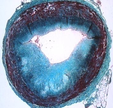 residual thrombus Disease progression AMI Lipidrich
