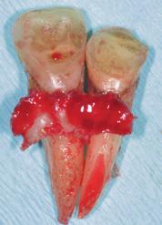 Operativer Eingriff (1 Monat nach dem Unfall) Nach Entfernung der Schiene wurden in Lokalanästhesie (Septanest, Fa. Septodont, SaintMaurdesFossés, Frankreich) die Zähne 11 und 1 extrahiert.