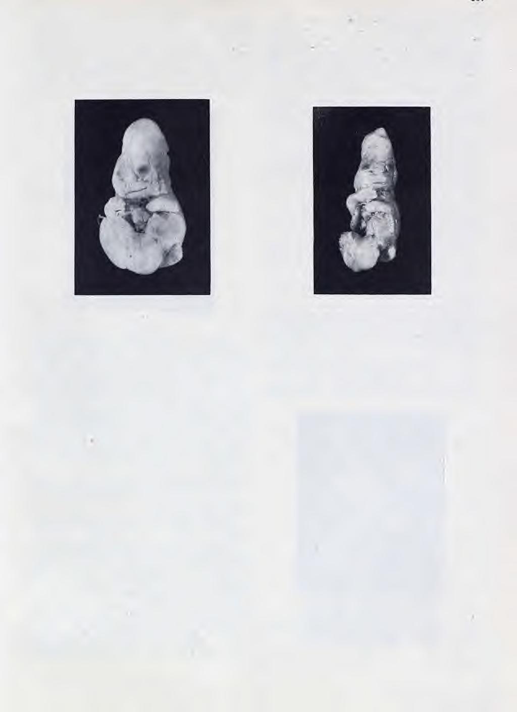 Werth dijeli vanmaterične višestruke trudnoće (»Mehrlingsschwangerschaft«) u tri grupe.