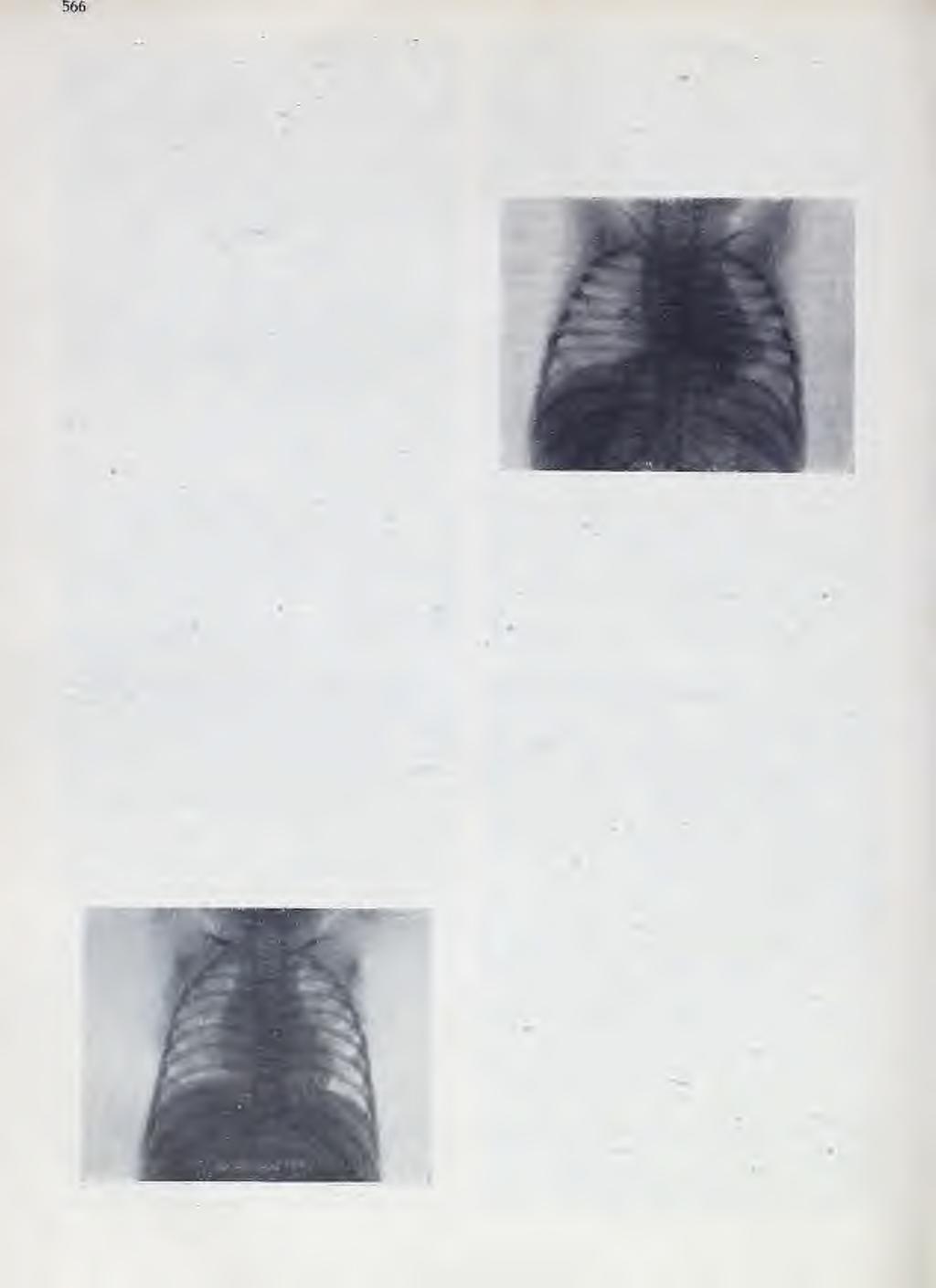 glavnih bronhusa, i 2.) ö s 1 a b 1j e n o ali poostreno disanje govori za kompresiju dovodnog bronhusa. Ekspiratorni i inspiratorni stertor.