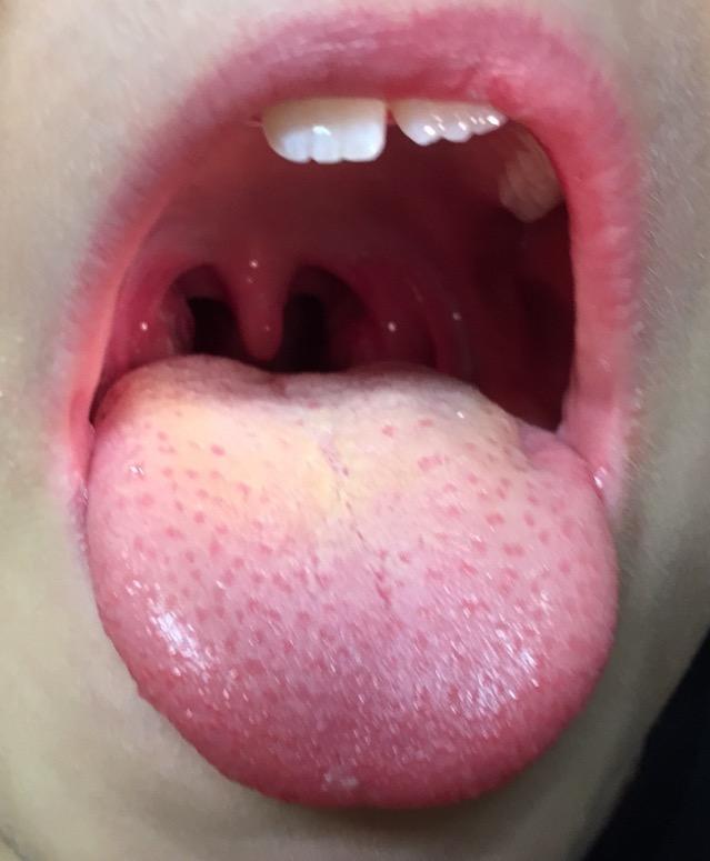 Tonsillitis 7 Jahre 2 gipfeliger Verlauf Anfangs