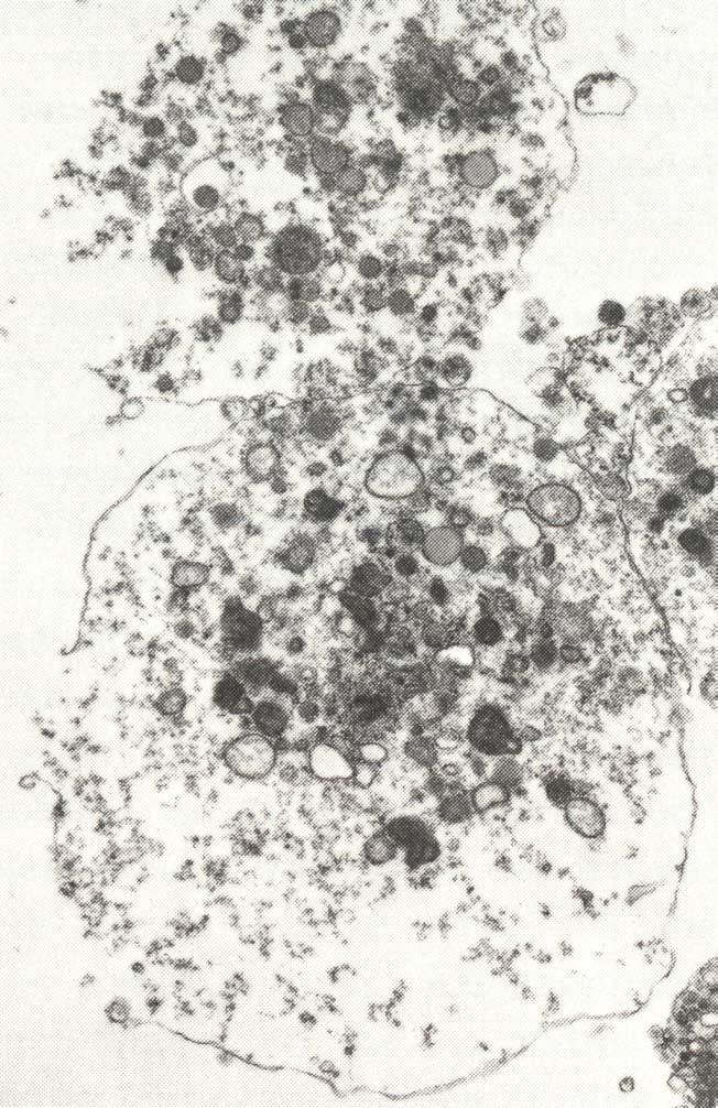 Nekrose Das morphologische Bild der Nekrose: Zelle platzt, Karyorhexis (Fragmentierung