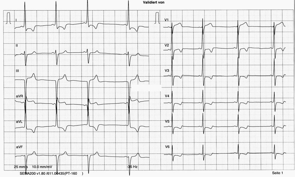 Hypertrophe Kardiomyopathie (HCM)