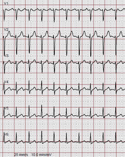 auf NFS, Patient wach, BD 140/90 mmhg