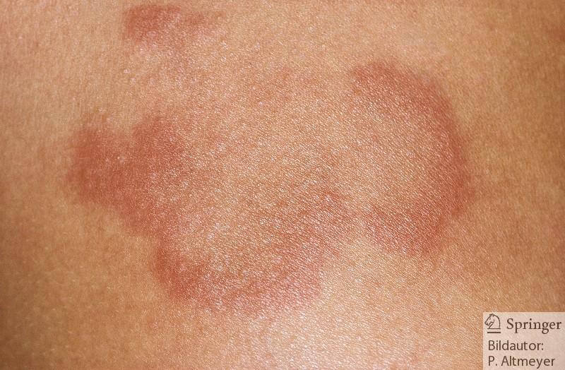 Erkrankungen des Endokards Rheumatisches Fieber Haut: -