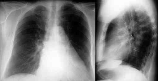 Herzgeräusch) EKG (P mitrale) Röntgen