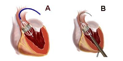 transcatheter aortic valve