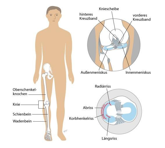Zeichnung: Hella Maren Thun, Grafik-Designerin Typische Ursachen Ein Meniskusriss ist eine typische Sportverletzung. Die Ursache ist meist eine Rotation im Knie.