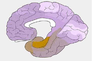 Alzheimersche Krankheit In der Frühphase spezifische Defizite in der Gedächtnisbildung Frühe Veränderungen (Degeneration) in spezifischen Bereichen des Temporallappens, vor allem im