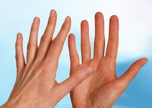 Klinisch relevante Hautareale Fingerkuppen und Daumen sind klinisch besonders wichtig, da sie am Häufigsten