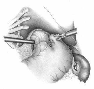 Bauchhöhle: Speiseröhre 151 6 Bildung dorsaler Fundusfalte Nach vollständiger Hiatoplastik wird eine dorsale Fundusfalte hinter der mobilisierten Kardia hindurch gezogen.