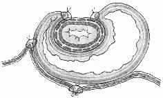 Bauchhöhle: Speiseröhre 153 9 Fundoplicatio nach Toupet Partielle hintere Fundoplicatio nach Toupet.
