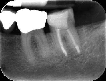 Bei deutlich zu kurzer Wurzelkanalfüllung muss der verbliebene Hohlraum des Wurzelkanals bis zum physiologischen Apex als Ursache einer Läsion endodontischen Ursprungs (LEO = Lesion of endodontic
