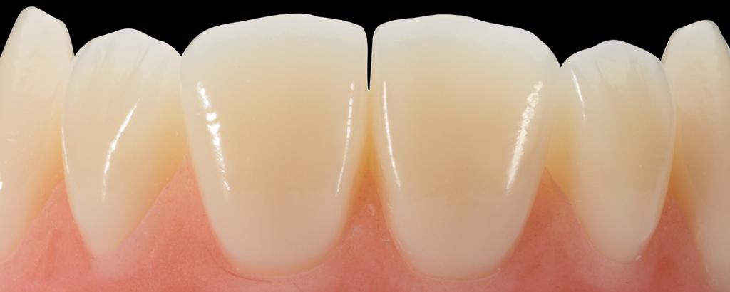 Zudem könnte der Zahn als leicht gedreht wahrgenommen werden, da bei einer zu weit lateral verlaufenden Kantenlinie der Übergang zum Approximalbereich optisch verkürzt bzw.